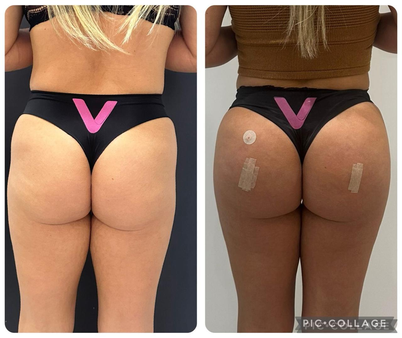 Resultado antes e depois 2 de 6