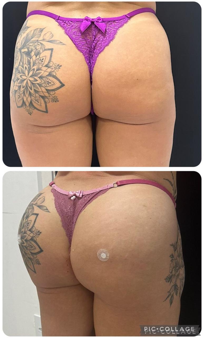 Resultado antes e depois 3 de 6