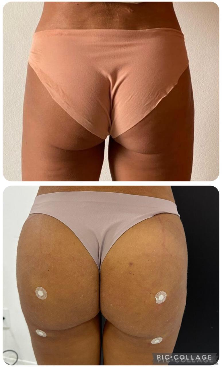 Resultado antes e depois 4 de 6