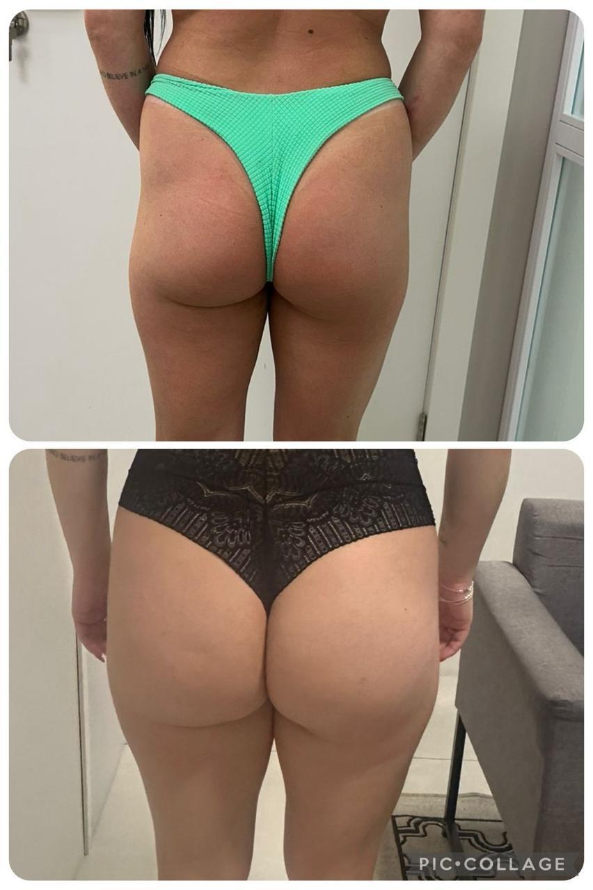 Resultado antes e depois 5 de 6