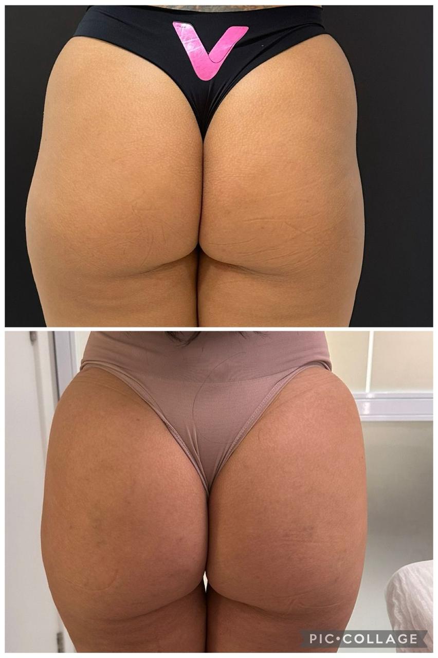 Resultado antes e depois 6 de 6